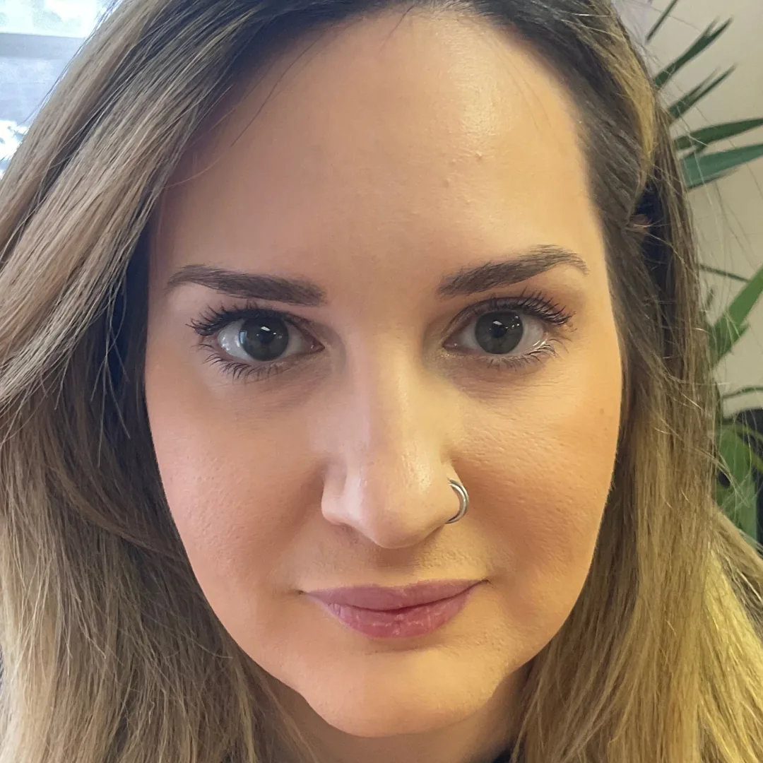 After Botox treatment with smoother forehead and softened expression lines