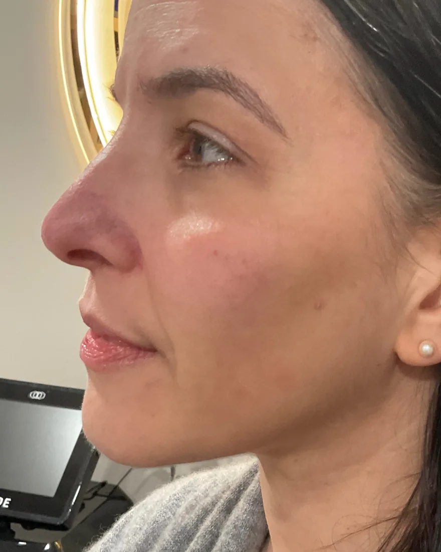 After cheek filler treatment with restored natural facial volume