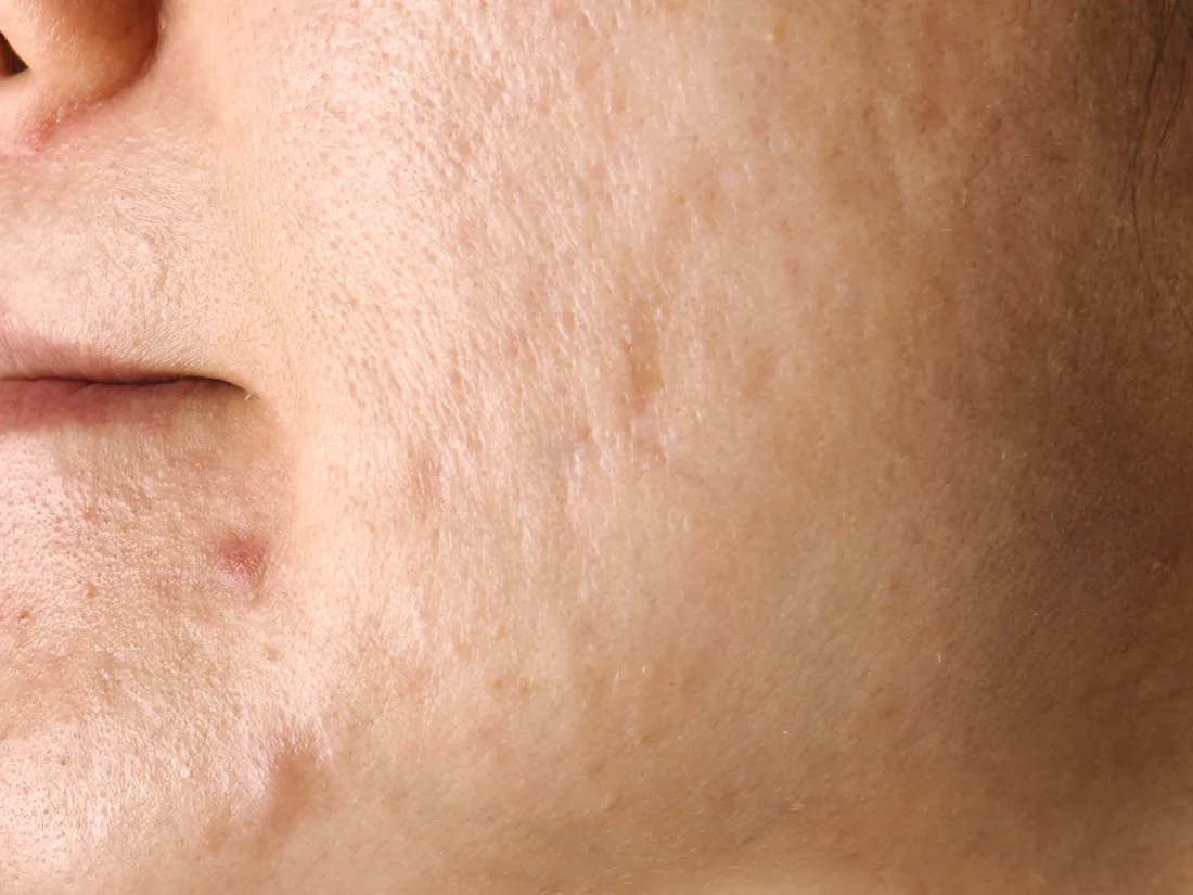 Close-up of pitted acne scarring on the cheek