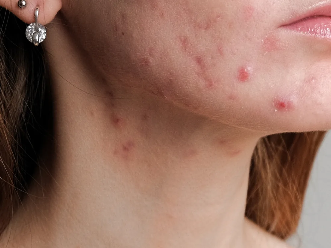Close-up of a jawline with active acne breakouts