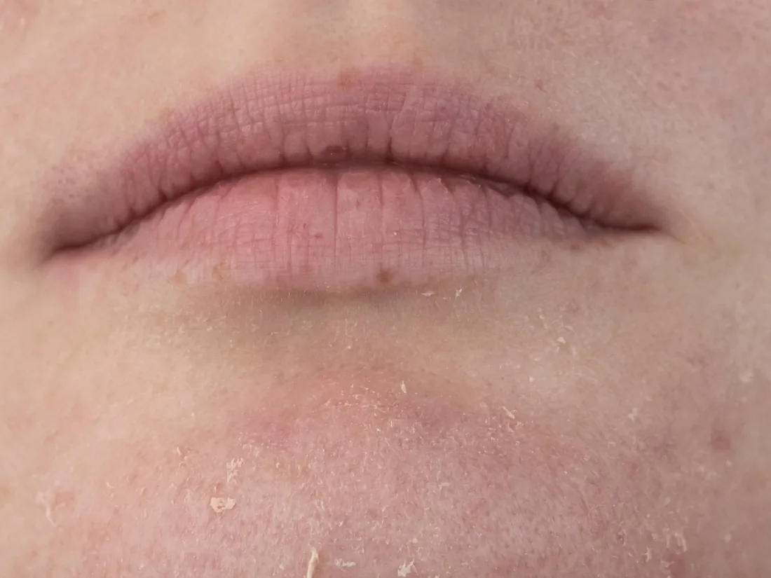 Close-up of dry, flaky skin around the lips and chin