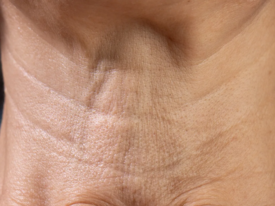 Close-up of loose, crepey skin and lines on the neck