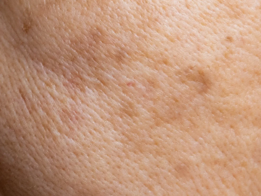 Close-up of melasma and dark pigmentation spots on the skin