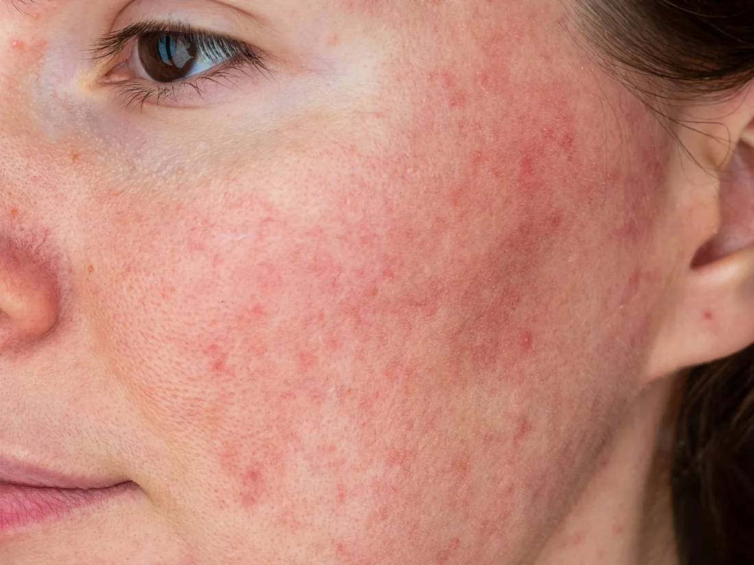 Close-up of facial redness and rosacea across the cheek