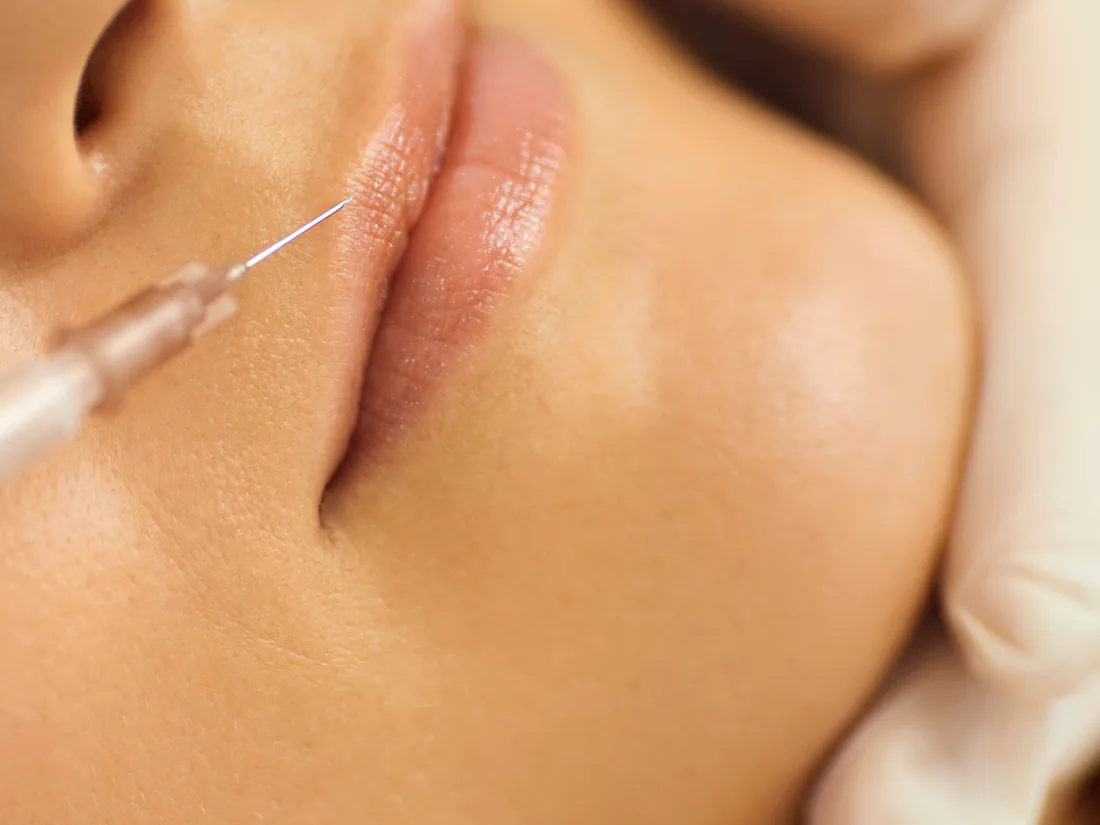 Lip filler being injected to add volume to thin lips