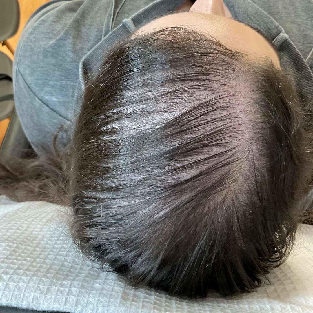 Before and after hair restoration treatment showing fuller healthier hair growth after