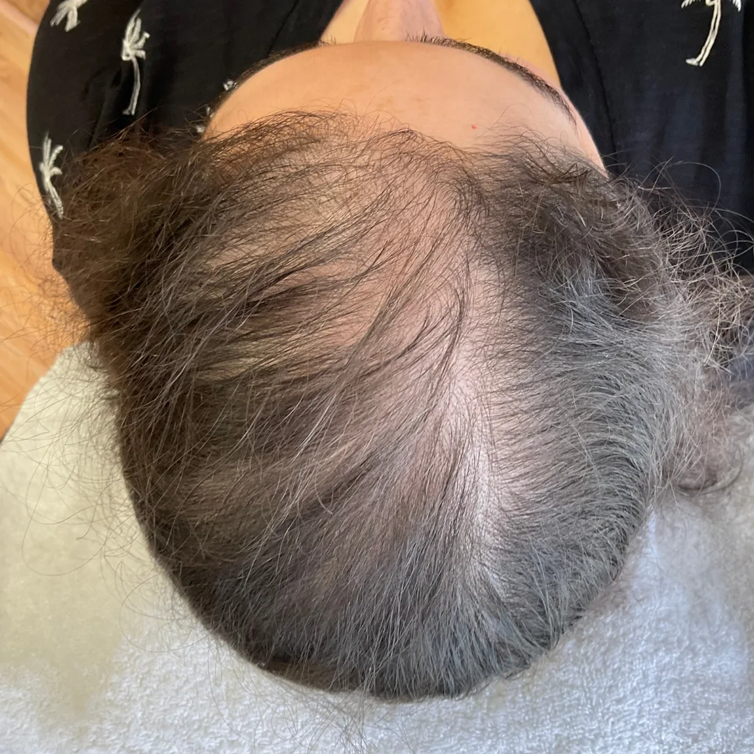 Before and after hair restoration treatment showing fuller healthier hair growth before
