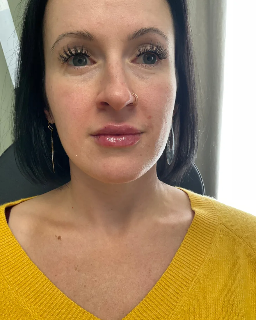 Before and after lip and facial filler treatment with subtle balanced results after