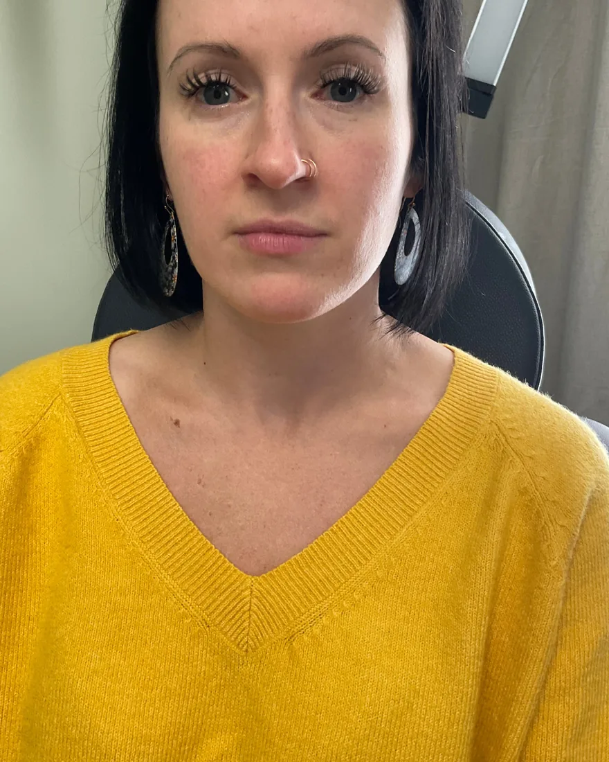 Before and after lip and facial filler treatment with subtle balanced results before