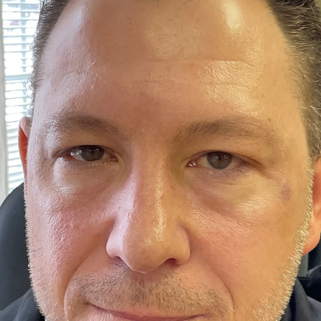 Before and after microneedling treatment showing smoother and brighter skin after