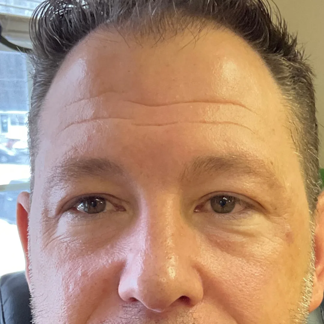 Before and after microneedling treatment showing smoother and brighter skin before