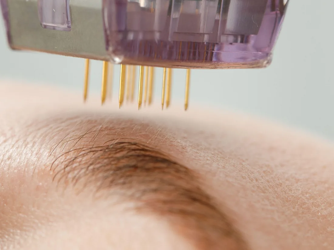 Microneedling pen treatment being performed on a client's skin at LushRX Aesthetics