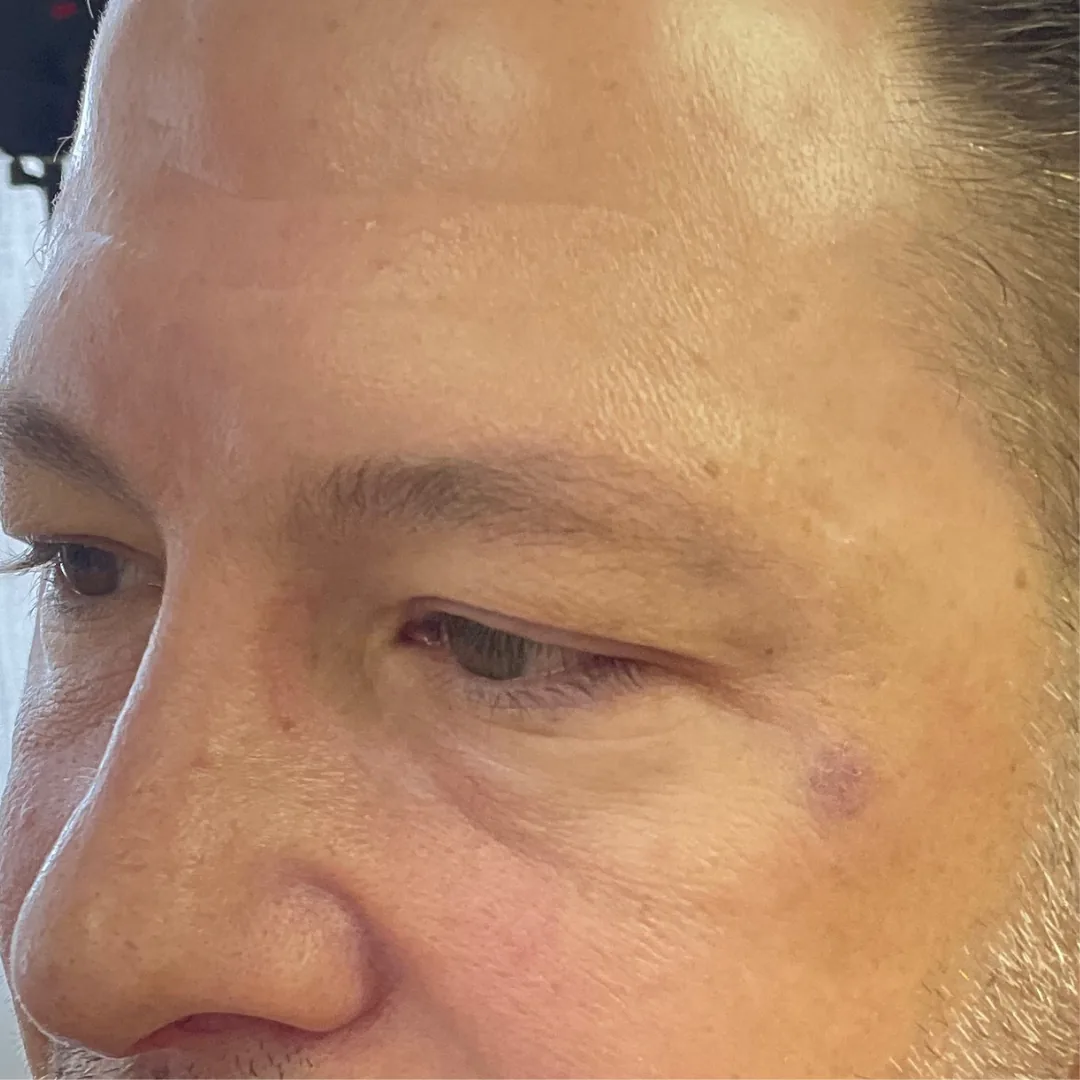 Before and after microneedling with exosomes improving skin texture after
