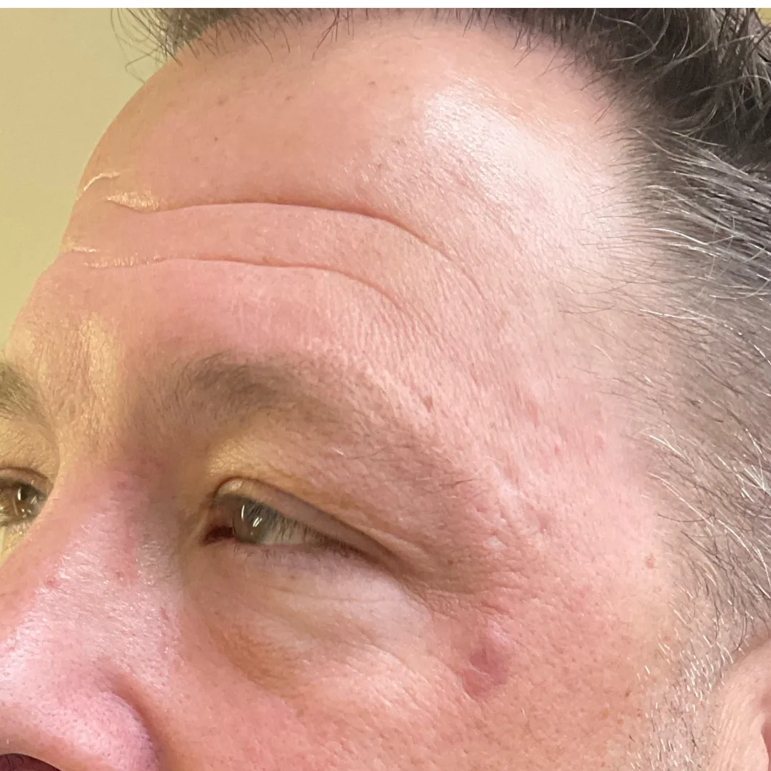 Before and after microneedling with exosomes improving skin texture before