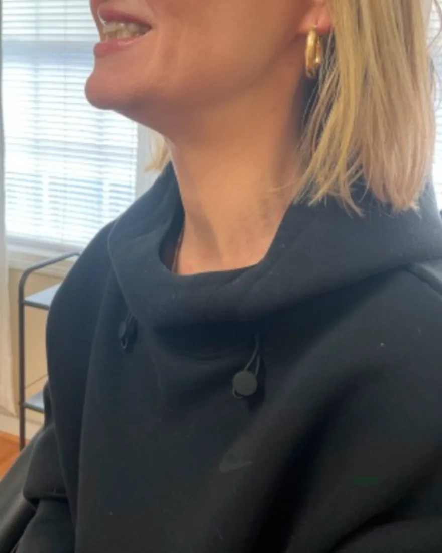 Before and after Nefertiti lift jawline and neck contouring after