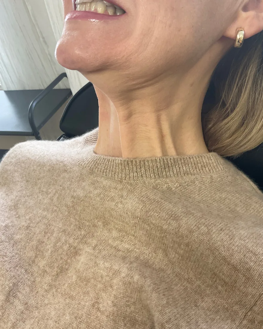 Before and after Nefertiti lift jawline and neck contouring before