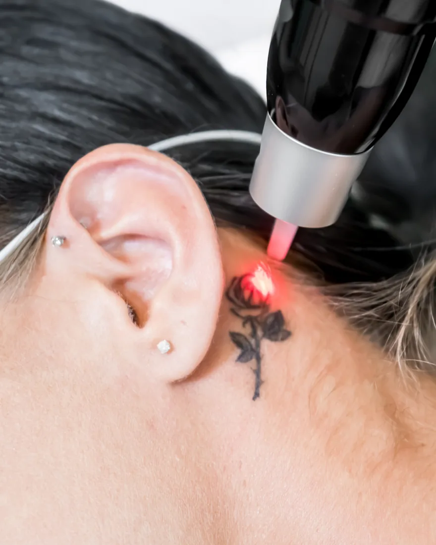 Pico laser removing a small tattoo behind a client's ear at LushRX Aesthetics