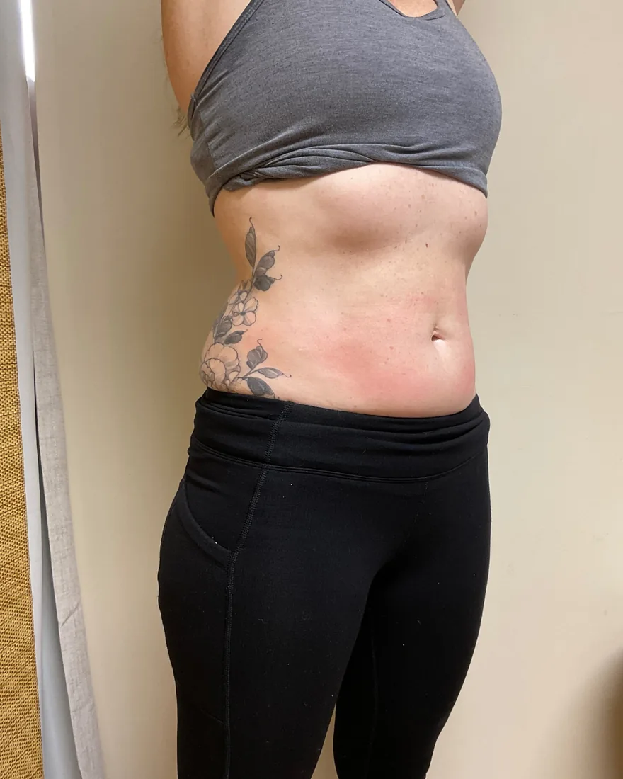 Abdomen after 4K ultrasound body sculpting showing a slimmer waistline