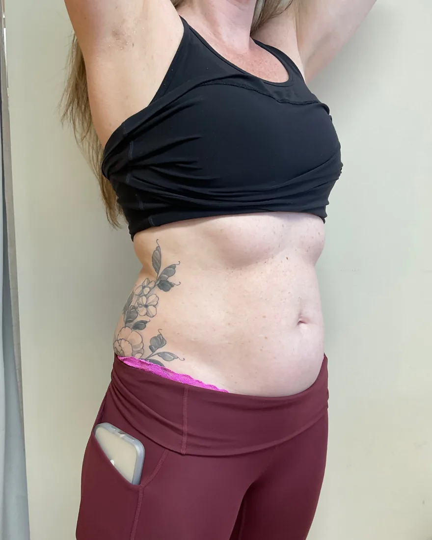 Abdomen before 4K ultrasound body sculpting treatment